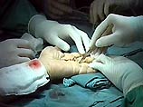  В Испании хирурги пришили пациенту оторванную руку к ноге, а потом вернули ее на место