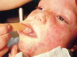 Все россияне в возрасте до 35 лет пройдут вакцинацию против кори до конца года Все россияне в возрасте до 35 лет пройдут вакцинацию против кори до конца года