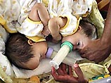 В США успешно прошла операция по разделению сиамских близнецов В США успешно прошла операция по разделению сиамских близнецов