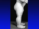 Вследствие генетических изменений мускулы родившегося в Берлине мальчика вдвое превосходят по размеру мускулы обычных людей
