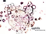 Тревогу бьют американские врачи. По данным специалистов Университета Вашингтона в Сиэтле, минимум 10% заразившихся сифилисом по всему миру могут быть поражены новой разновидностью