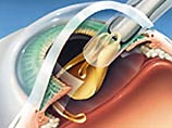 В США разрабатывают имплантаты, которые смогут восстанавливать зрение