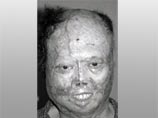 54-летний мужчина был прооперирован врачами токийского медицинского центра Hiroo. Загоревшийся бензин сжег кожу его лица, шеи, груди и рук. У него не осталось носа, и очень сильно пострадали уши