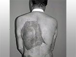 Используя уникальные технологии, ученые в течение 6 месяцев "растягивали" кожу на его спине, чтобы взять необходимый для операции участок размером 28Х27 см