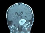 Использование мобильного телефона в течение 10 лет может привести к опухоли слухового нерва Использование мобильного телефона в течение 10 лет может привести к опухоли слухового нерва