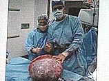 Во время операции врачи извлекли из тела женщины опухоль весом 29 кг (ФОТО)