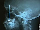 Новую "головную боль" доставил американцу счет на 100 тысяч долларов за операцию по удалению гвоздя Новую "головную боль" доставил американцу счет на 100 тысяч долларов за операцию по удалению гвоздя