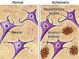 Ученые научились лечить болезнь Альцгеймера у мышей: на очереди люди