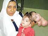 В Египте проведена операция по удалению второй головы у 10-месячной девочки