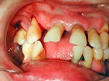 Изогнутые зубы с нарушением рядности могут быть результатом того, что люди начали есть относительно мягкую, приготовленную пищу, предполагают авторы нового исследования