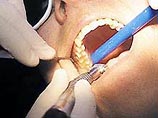 Сегодня единственным способом лечения дыр в зубах является установка пломбы. Для этого врач должен высверлить пораженный участок зуба и залить образовавшуюся полость особым раствором