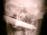 В голове у 61-летнего Вороновича нашли 12-сантиметровое лезвие от кухонного ножа