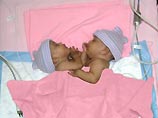 В Саудовской Аравии врачи смогли разделить сиамских близнецов Алю и Валю