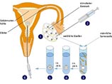 Процедуры IVF искусственного оплодотворения