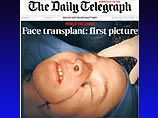 В конце ноября 2005 года во Франции команда медиков под руководством Жана-Мишеля Дюбернара пересадила 38-летней женщине нос, губы и подбородок