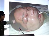 В Китае проведена вторая в мире операция по пересадке лица. Пациент - 30-летний Ли, который полтора года назад потерял правую часть лица и нос в результате нападения медведя