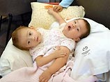 Медики в США за сутки разделили сиамских близнецов Медики в США за сутки разделили сиамских близнецов