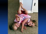 Врачи госпиталя в Солт-Лейк-Сити в американском штате Юта готовятся к разделению сиамских близнецов Кендры и Малийи Херрин