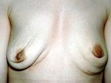США отменили действовавший 14 лет запрет на силиконовую грудь 