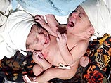 Врачи Саудовской Аравии успешно разделили сиамских близняшек из Ирака Врачи Саудовской Аравии успешно разделили сиамских близняшек из Ирака