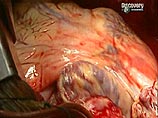 Врачи мадридского госпиталя впервые в мире имплантировали стволовые клетки в сердце      время публикации: 10:23   последнее обновление: 10:23                   В мадридском госпитале Грегорио Маранён впервые в медицинской практике человеку пересадили ств