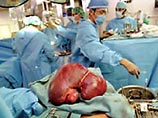 Из-за ошибки лаборанта итальянские трансплантологи пересадили трем пациентам органы ВИЧ-инфицированного донора