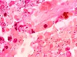 бактерии Klebsiella pneumoniae, невосприимчивые к большинству антибиотиков