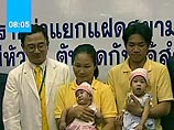 Тайские врачи первыми в мире разделили сиамских близнецов со сросшимися сердцами и печенью  