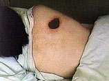 Сибирская язва - острая инфекционная болезнь, протекающая преимущественно в виде кожной формы, значительно реже - в легочной и кишечной формах