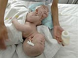 В Китае успешно разделили четырехмесячных сиамских близнецов В Китае успешно разделили четырехмесячных сиамских близнецов