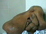 Китайские хирурги прооперировали "человека-слона": с лица и шеи удалена 15-килограммовая опухоль