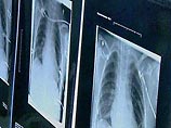 29-летняя женщина рассказала, что не знала о присутствии инородных предметов в своем теле до того, как на медицинском осмотре рентген показал наличие в организме 26 игл
