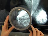 Половина россиян не знает о том, что рак излечим Половина россиян не знает о том, что рак излечим