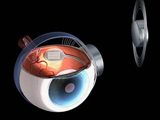 "Бионический" глаз частично возвращает слепым зрение