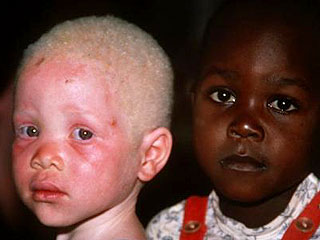 Правительства нескольких африканских республик озаботились судьбой негров-альбиносов