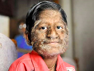 В Индии живет мальчик с редчайшим генетическим отклонением, называемым гипертрихоз: у страдающего им человека лицо и тело покрыты густым слоем волос, как у животных