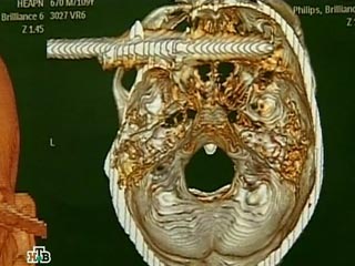Хирурги бразильского госпиталя Саракурана в ходе пятичасовой операции сумели извлечь 15-сантиметровое острие из головы непутевого рыбака