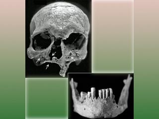 Разрушение костей около носа может быть признаком проказы, считает один из авторов исследования антрополог Гвен Роббинс из Аппалачского государственного университета