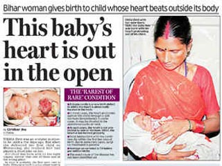 Ребенок с редчайшим врожденным пороком родился в Индии - сердце младенца из штата Бихар оказалось снаружи, пишет в субботу газета Mail Today
