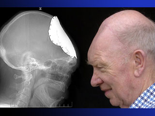 Уникальный случай в Великобритании: у 72-летнего пенсионера вырос новый череп 