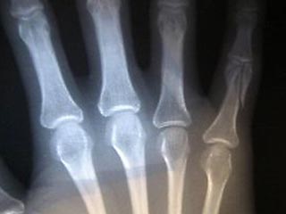 Милиционеры Московской области задержали 20-летнего юношу, который сломал палец врачу-травматологу. Теперь злоумышленнику грозит 3-летний срок лишения свободы