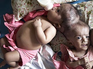 Двухлетние девочки-сироты из Бангладеш, Тришна и Кришна, срослись в чреве матери в области головы