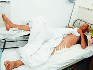 Китайские врачи перепутали у 84-летнего Джао Ронгбина правую и левую ноги и прооперировали здоровую