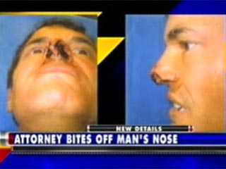 Опытный американский юрист откусил мужчине ноздрю в споре за место в туалете