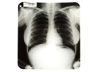 Рентгеновские снимки грудной клетки Мэрилин Монро продали за 45 тысяч долларов