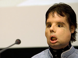 Мужчина, которому впервые в истории было полностью пересажено лицо, предстал перед телекамерами в Испании