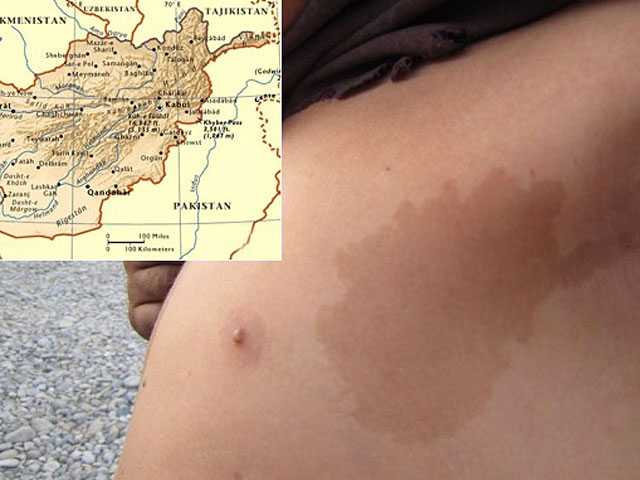 В Афганистане нашелся мальчик с родимым пятном в форме карты страны