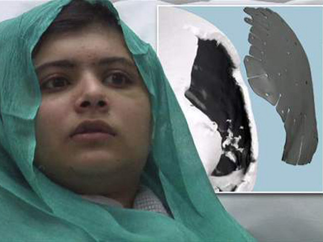 Британские врачи сделали успешную хирургическую операцию по реконструкции черепа и восстановлению слуха 15-летней пакистанской девочке Малале Юсуфзаи