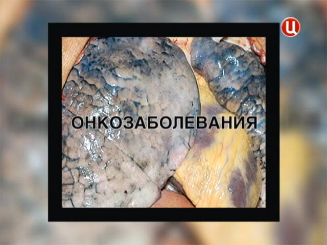 В России со среды, 12 июня, на сигаретных пачках производители обязаны в соответствии со вступившим в силу "Антитабачным" законом, размещать изображения, призванные иллюстрировать вред табакокурения