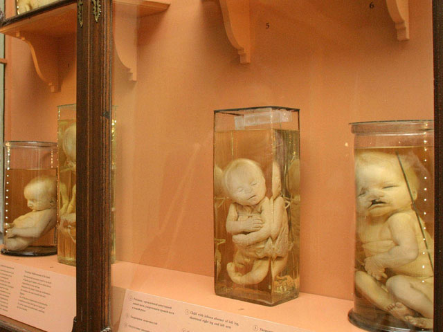 На Алтае посетительница выставки "Кунсткамера" украла колбы с сиамскими близнецами